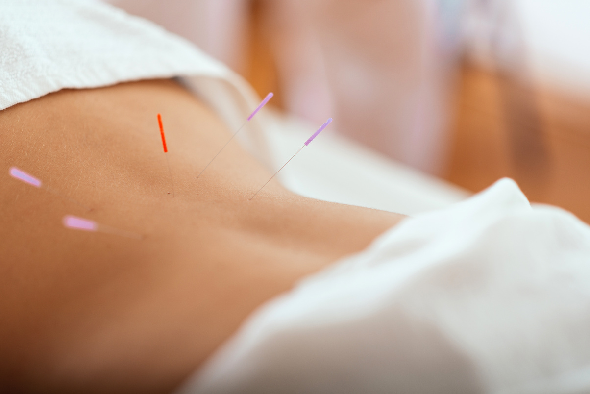 Acupuncture treatment